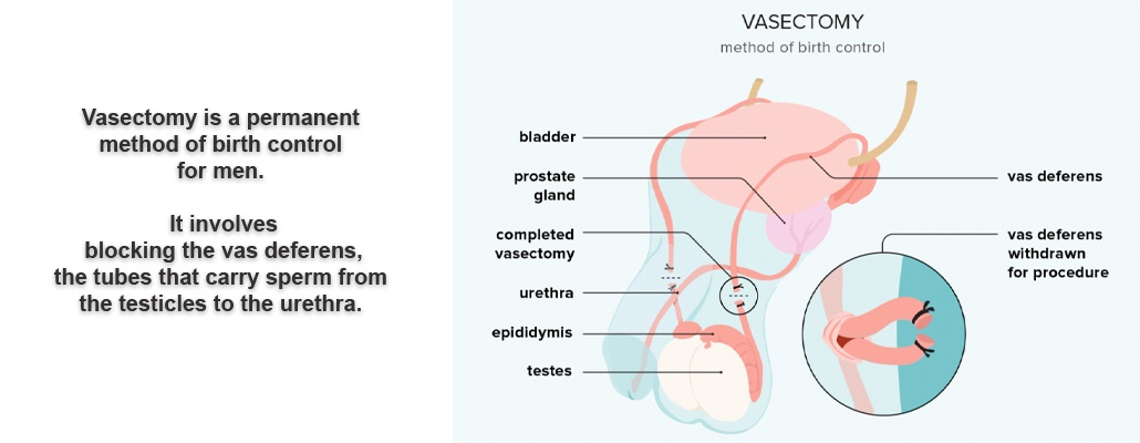 Vasectomy vs Laparoscopic Vasectomy Meerut
