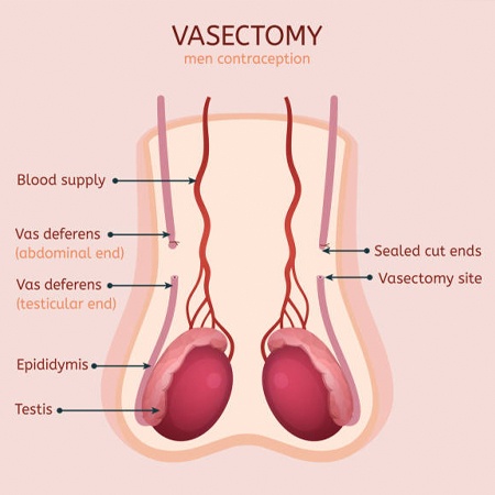 Leading Vasectomy & Laparoscopic Vasectomy Clinic Meerut