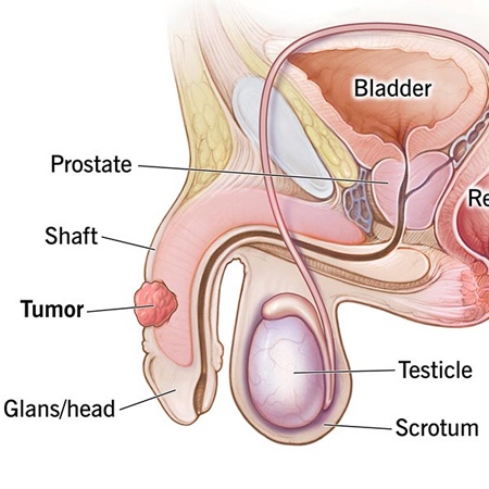 Penis Cancer Treatment & Surgery Meerut
