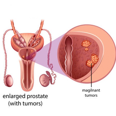 Prostate  Cancer Treatment & Surgery Meerut