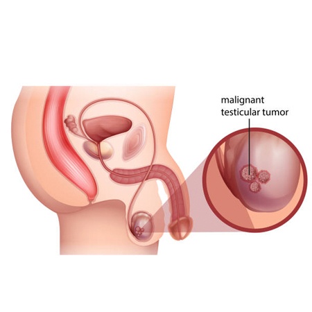 Testicular Cancer Treatment & Surgery Meerut