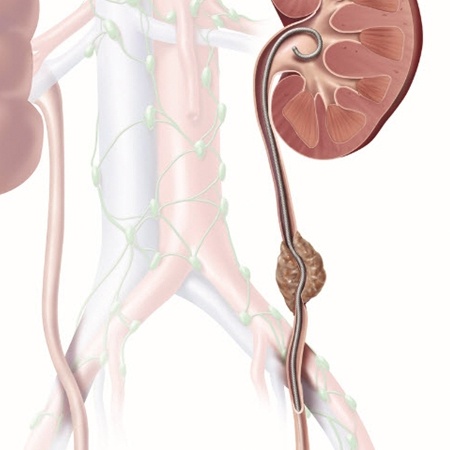 Ureteral Cancer Treatment & Surgery Meerut