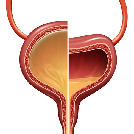 Over Active Bladder Symptoms
