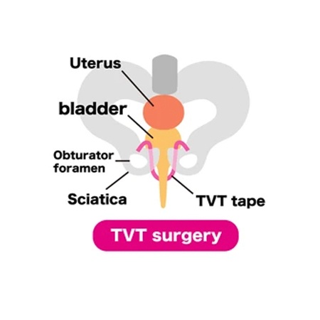 Best TOT TVT Surgery Treatment In Meerut Meerut Urologist