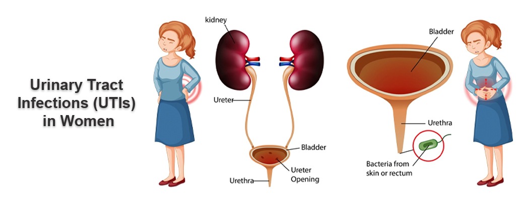 UTI Treatment Meerut