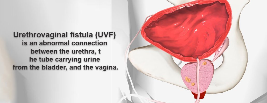 UVF Treatment & Surgery Meerut