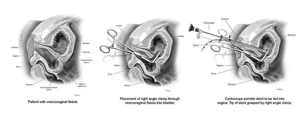 VVF Treatment & Surgery in Meerut