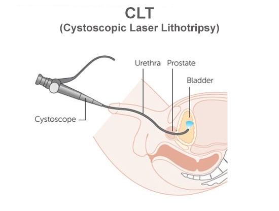Best CLT Surgery in Meerut