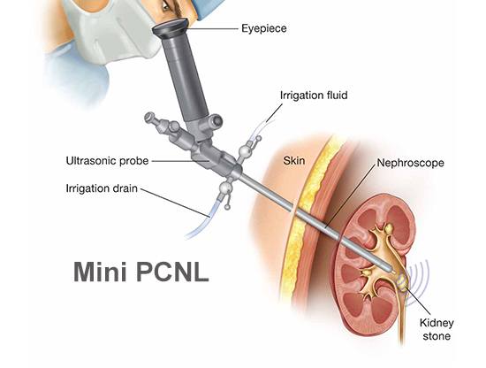 Best Mini PCNL Surgery in Meerut