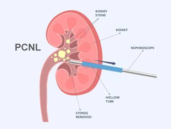 Percutaneous Nephrolithotomy Meerut