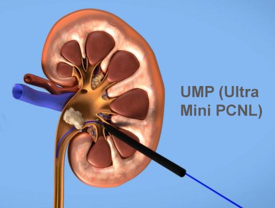 Best UMP Surgery in Meerut