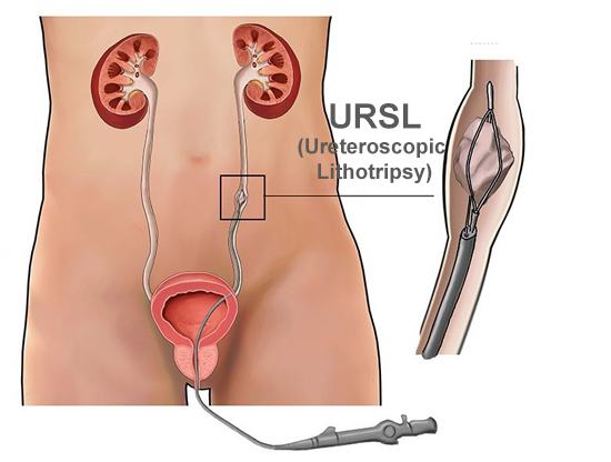 Best URSL Surgery in Meerut