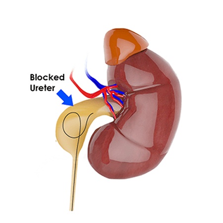 Comprehensive Laparoscopic Pyeloplasty Care Meerut
