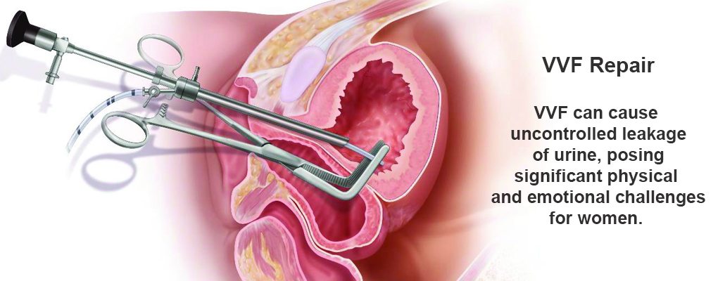 Laparoscopic VVF Repair Surgery Meerut