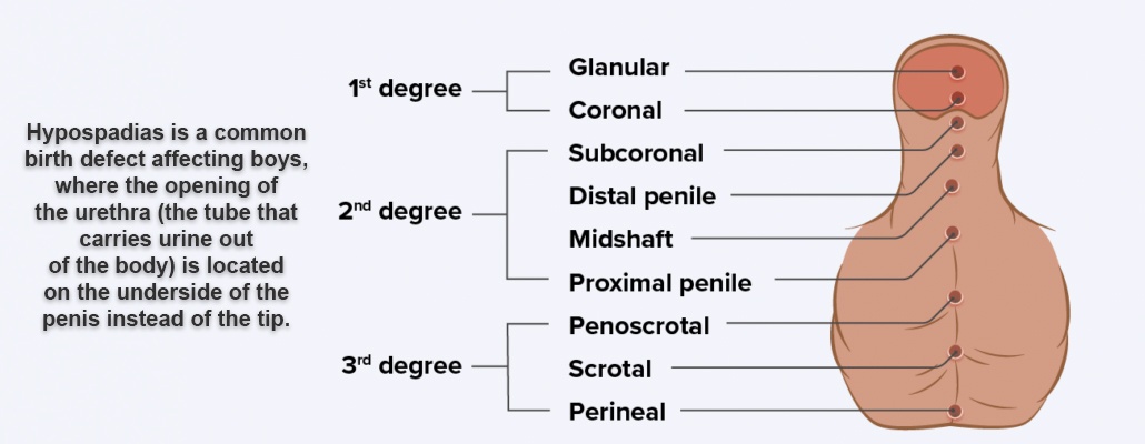 Hypospadias Treatment Meerut