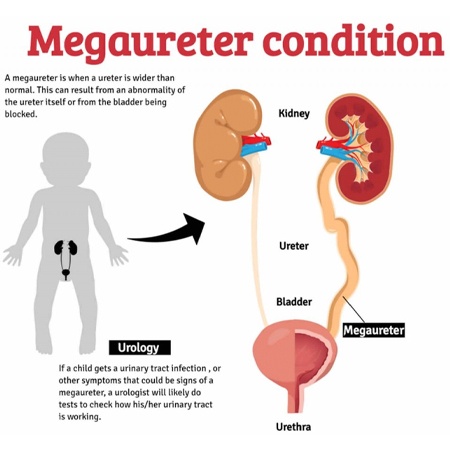  Megaureter Voiding Dysfunction Conditions