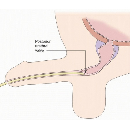 Posterior Urethral Valves Symptoms