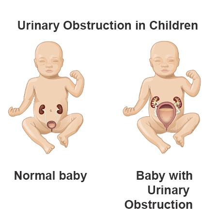 Urinary Obstruction Causes