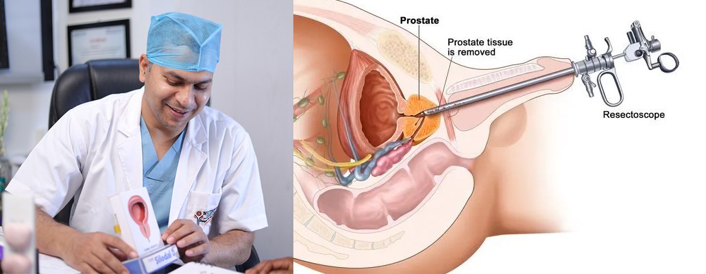 Best BiPolar TURP Surgery in Meerut