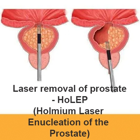 Best Laser Holep & Laser Thulep Surgery in Meerut