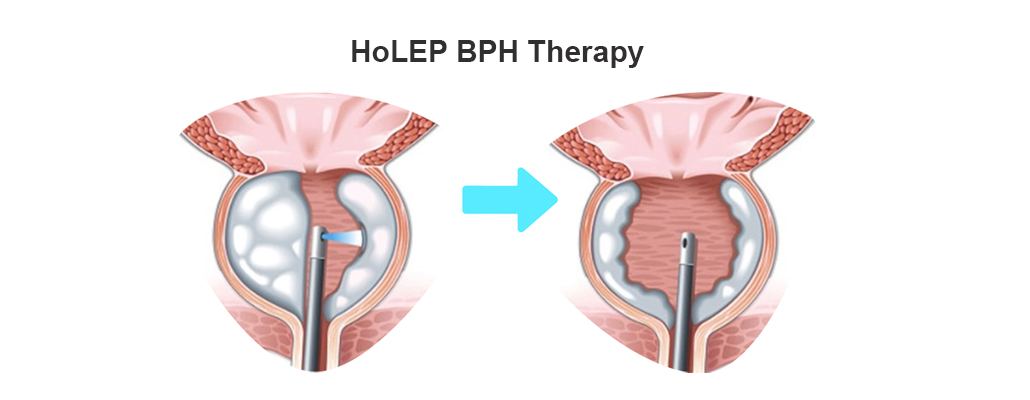 Comprehensive Laser Holep & Laser Thulep Care Meerut