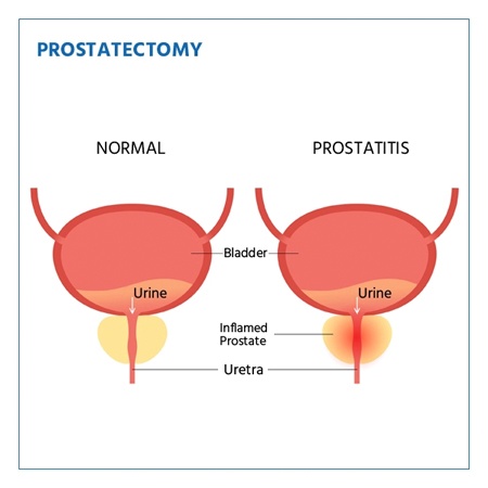 Open Prostatectomy Recovery Specialists Meerut