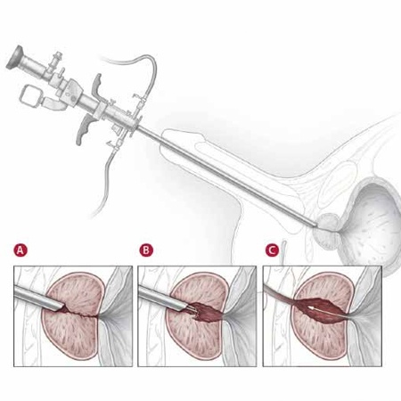 Saline TURP Recovery Specialists Meerut