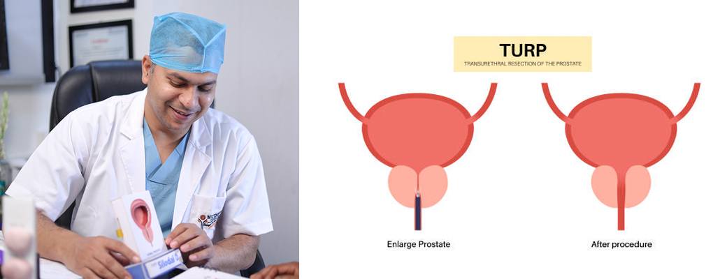 Top TURP Surgeons Meerut