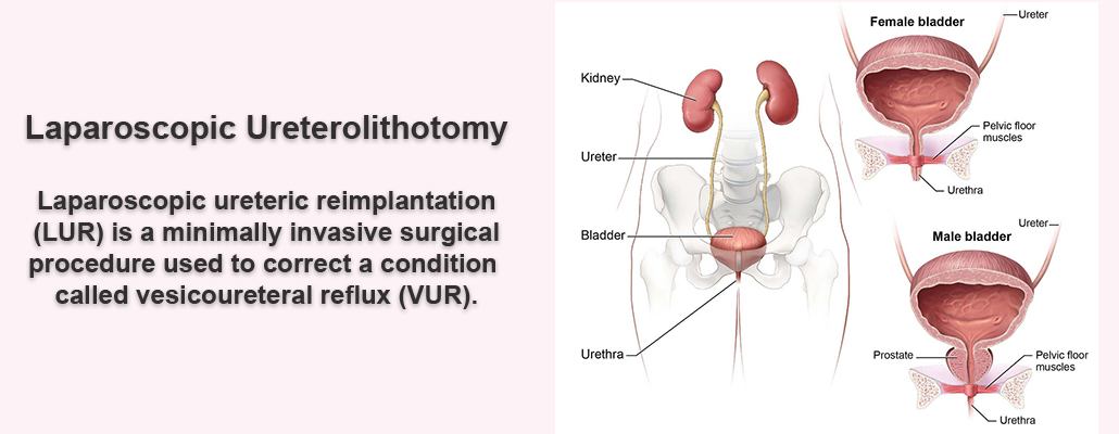 Laparoscopic Ureteric Reimplantation Surgery Meerut