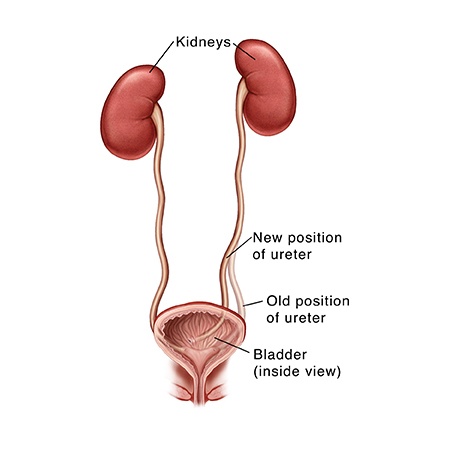 Vesicoureteral Reflux (VUR) Meerut
