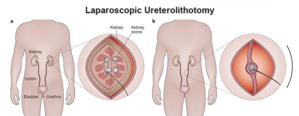 Laparoscopic ureterolithotomy Surgery Meerut