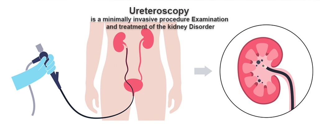 Ureteroscopy (URS) Surgery Meerut