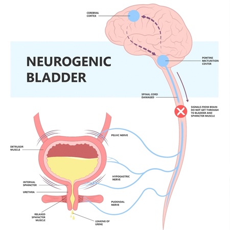 Neurogenic Bladder Causes